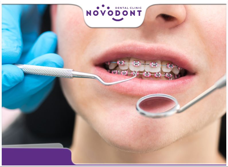 Tùy vào từng trường hợp, tình trạng răng hô hay móm mà niềng răng có phải nhổ răng không?