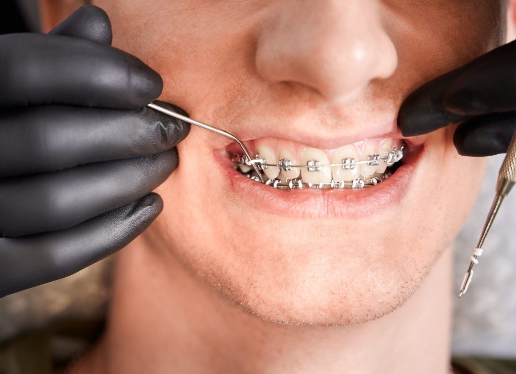 Có nhiều yếu tố ảnh hưởng tới giá niềng răng hô nhẹ.