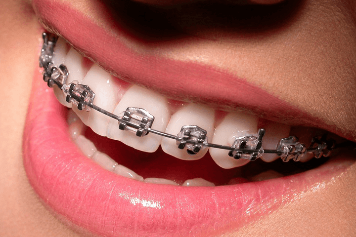 Niềng răng mắc cài kim loại ở phía bên ngoài của mặt răng 