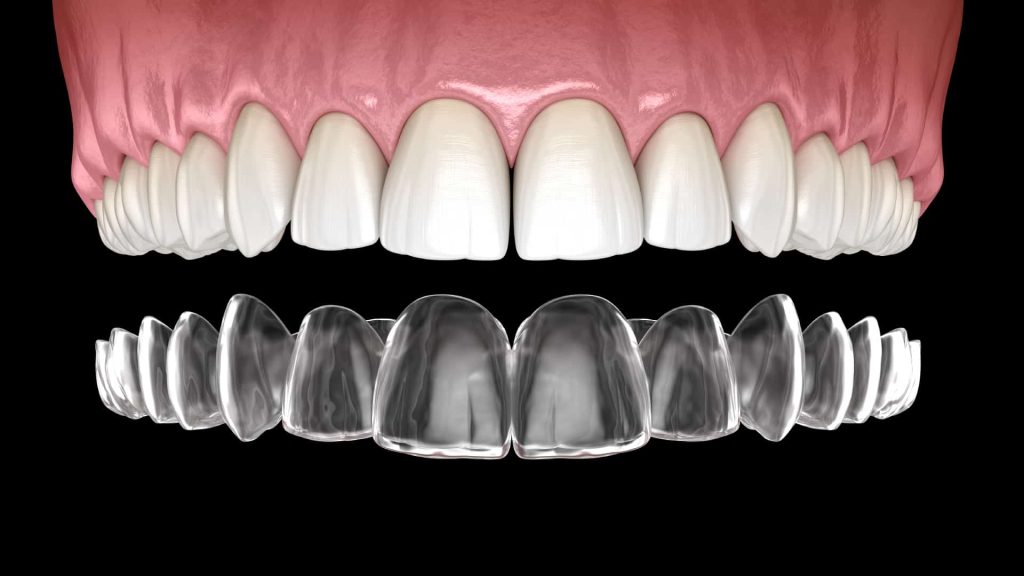 Niềng răng loại nào là tốt nhất? Invisalign là phương pháp chỉnh nha được sử dụng rộng rãi nhờ tính thẩm mỹ và cảm giác tự nhiên khi niềng 