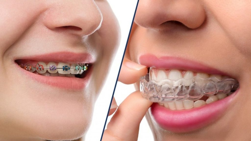 Niềng răng loại nào là tốt nhất? So với niềng răng mắc cài, niềng răng trong suốt có tính thẩm mỹ cao nhưng chi phí điều trị lớn