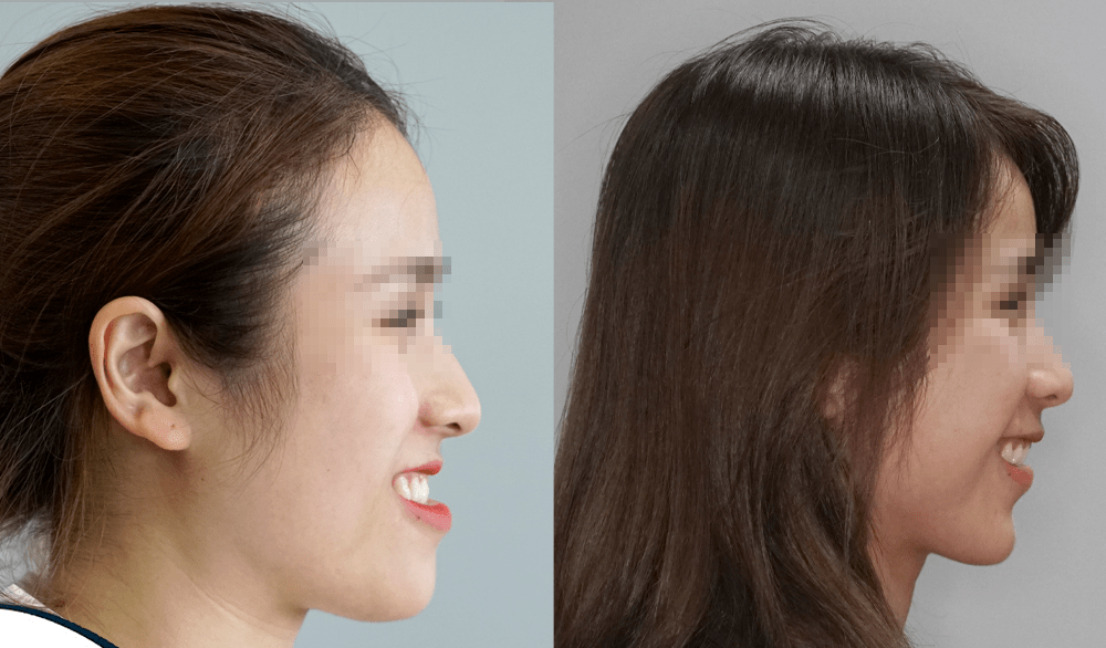 Hình ảnh trước và sau niềng răng móm
