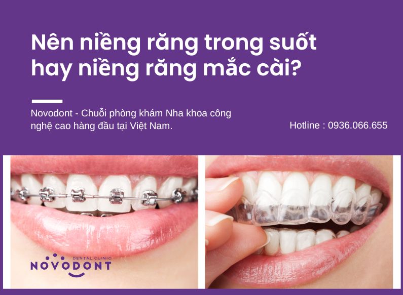 Nên niền răng trong suốt hay niềng răng mắc cài?