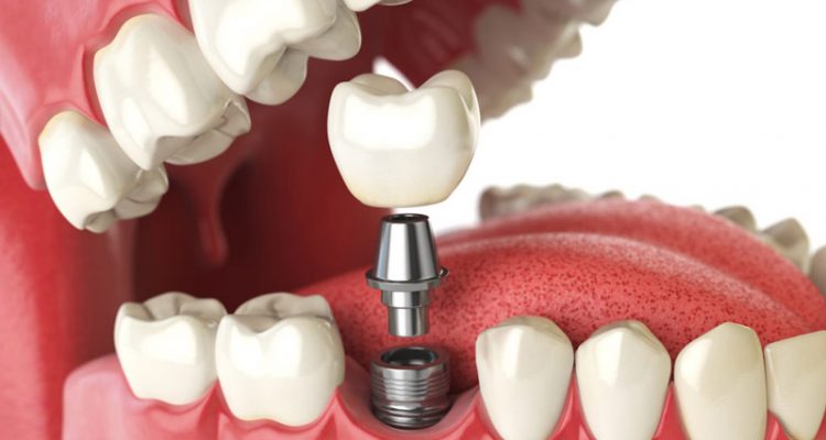 Phương pháp trồng răng Implant được hiểu là sử dụng trụ vào trong xương hàm và gắn mão sứ lên trên
