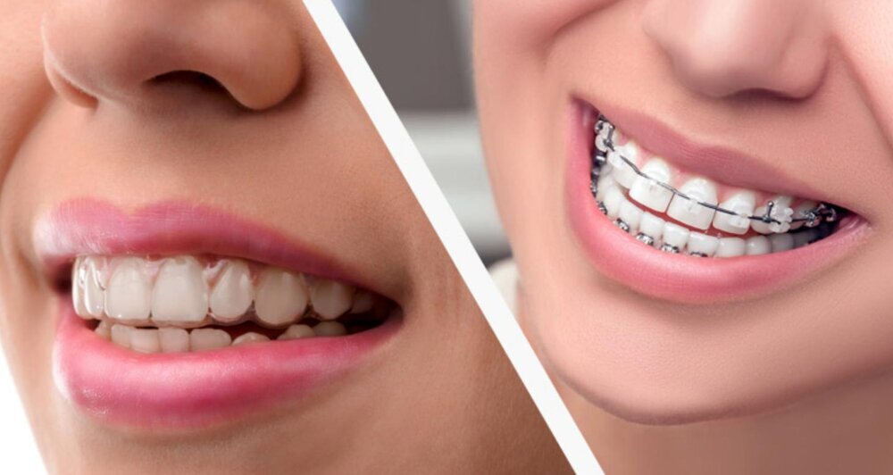 Phương án điều trị phổ biến và hiệu quả khi răng chìa ra ngoài là chỉnh nha.