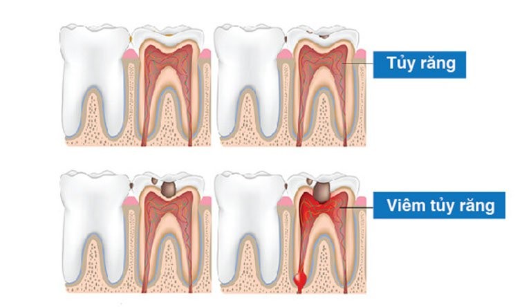 Tủy răng khi bị viêm cần được loại bỏ