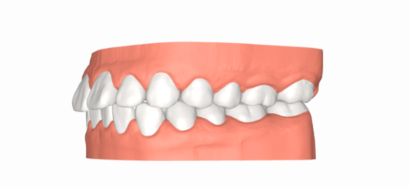 Bọc răng, trám răng, chỉnh nha, phẫu thuật là những phương pháp phổ biến điều trị răng hô nhẹ
