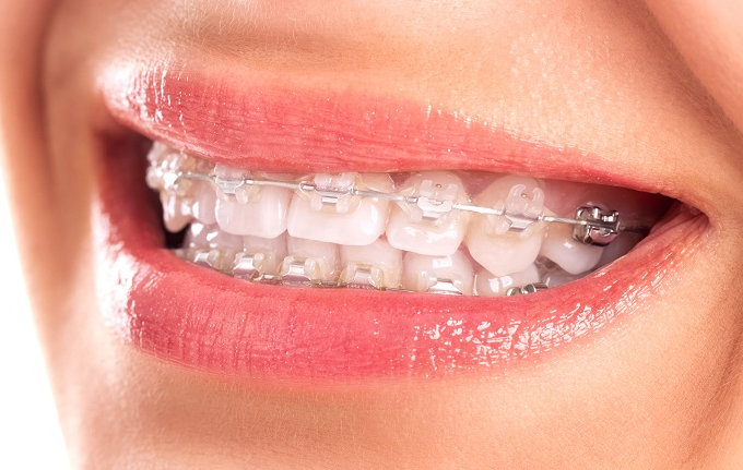 Bọc răng sứ có niềng được không? Tùy vào tình trạng sức khỏe răng miệng, trường hợp cụ thể, răng sứ có thể niềng hay không?