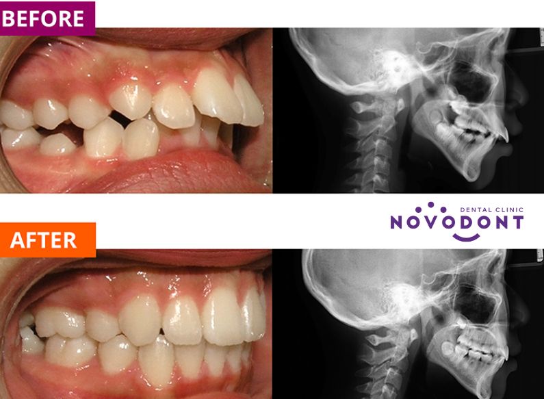 Hình ảnh trước và sau khi niềng răng vẩu: Cải thiện 80% 