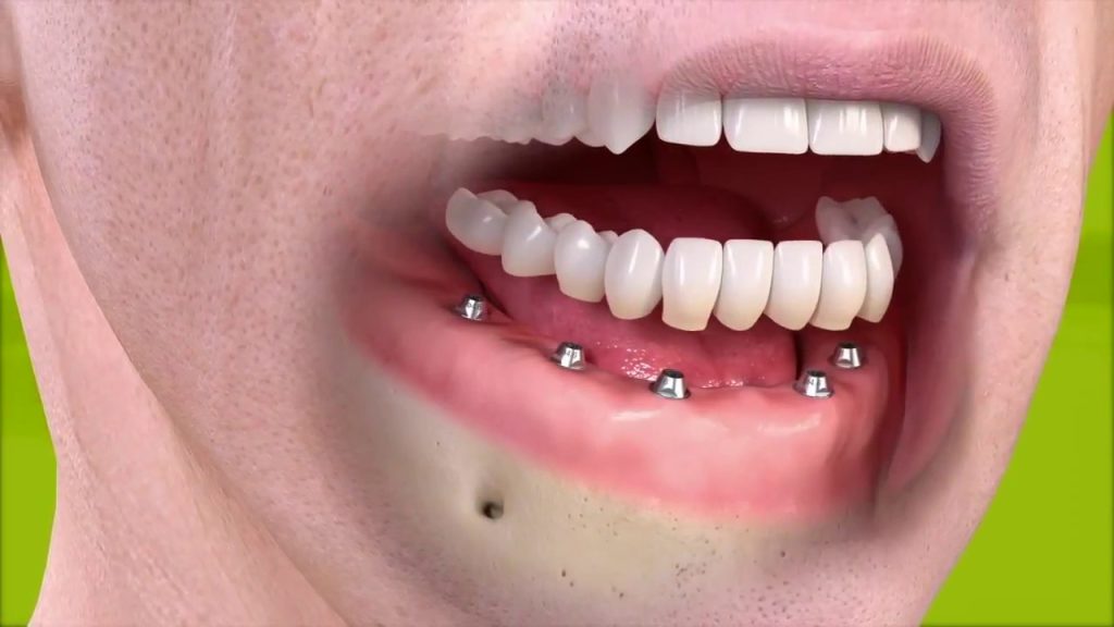 Ghép răng Implant được xem là một trong những phương pháp trồng răng có kết quả tốt nhất 