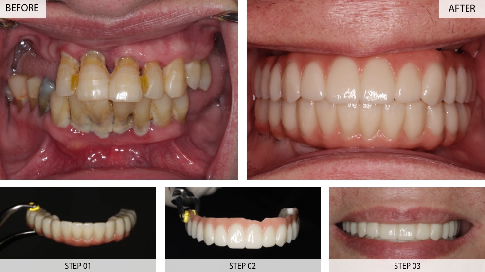 Sự khác biệt trước sau sau khi trồng răng Implant- phương pháp cấy ghép răng tiên tiến 