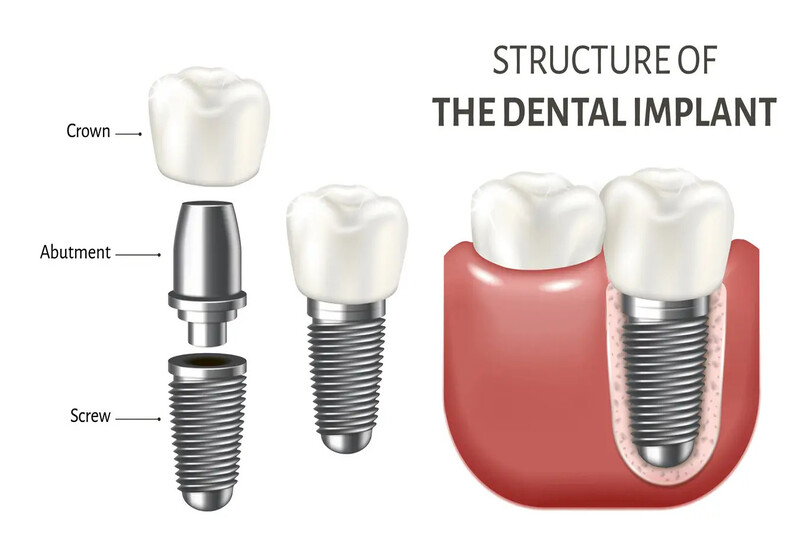 Trồng răng implant là gì? Là phương pháp phục hình răng được ưa chuộng hiện nay