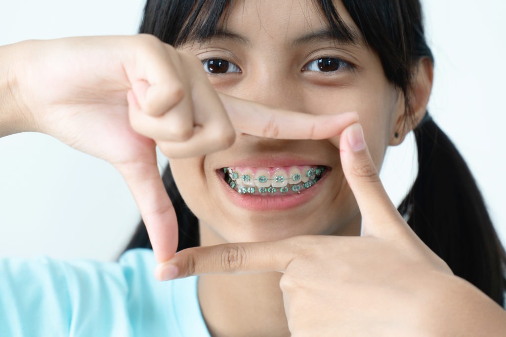 Niềng răng ở độ tuổi nhỏ sẽ luôn thích hợp hơn so với độ tuổi trưởng thành 
