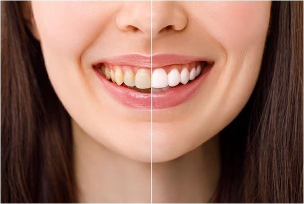 Hình ảnh trước và sau bọc răng sứ