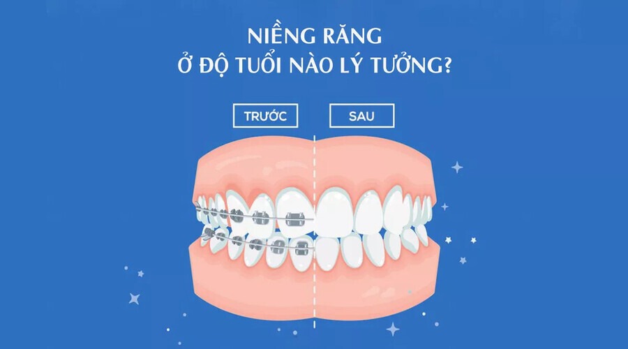 Bao nhiêu tuổi thì không niềng răng được? Từ 30 tuổi trở đi bạn nên cân nhắc kỹ khi muốn chỉnh nha