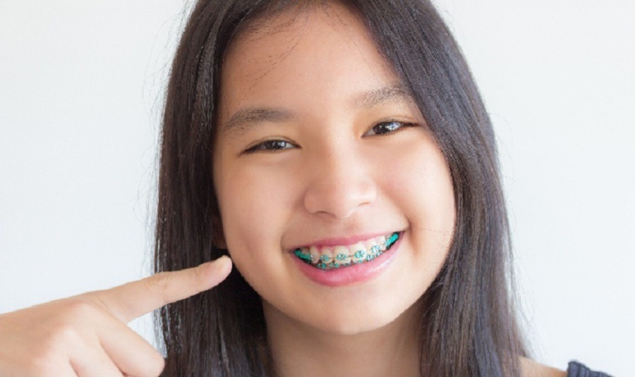 Bao nhiêu tuổi thì niềng răng được? Liệu có nên cho trẻ em niềng răng sớm hay không?