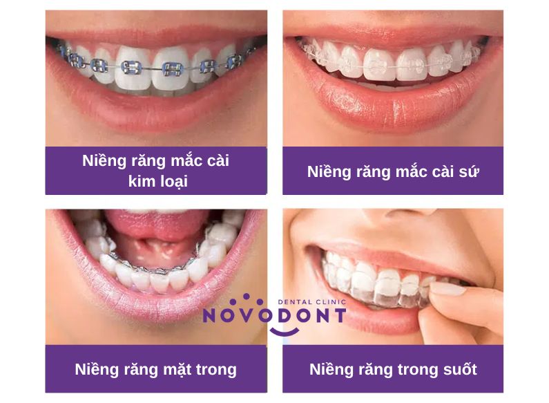 4 loại niềng răng hiện nay