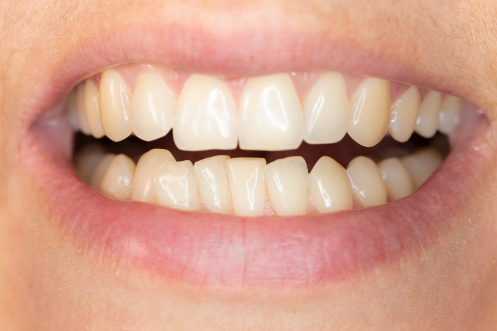 Trong bức ảnh này bệnh nhân đang gặp tình trạng răng lệch nhẹ ở một số vị trí