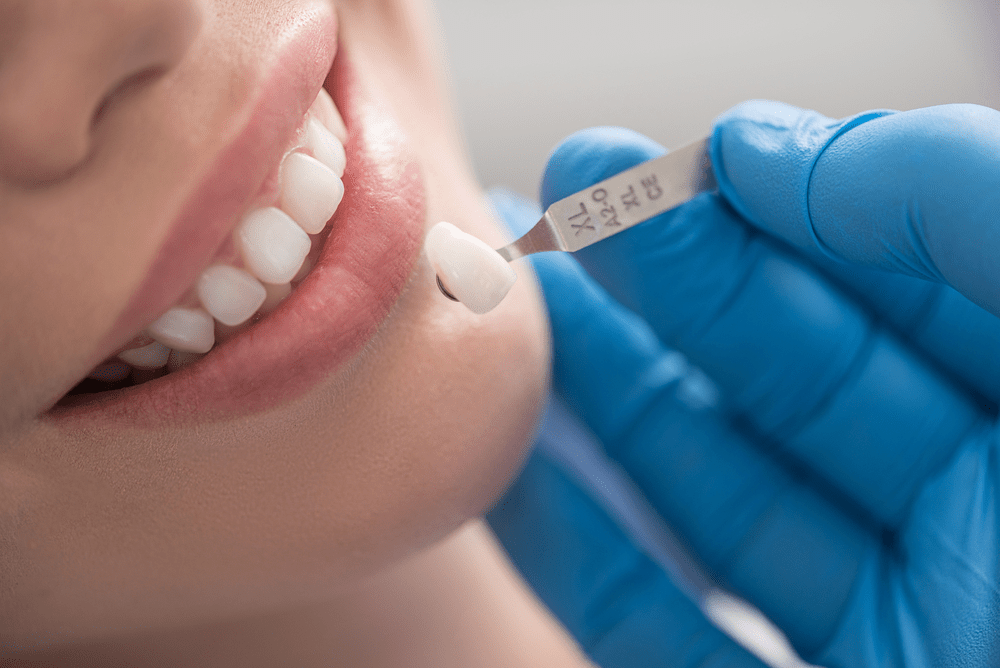 Thực hiện phương pháp bọc sứ sẽ giảm thời gian đáng kể so với niềng răng