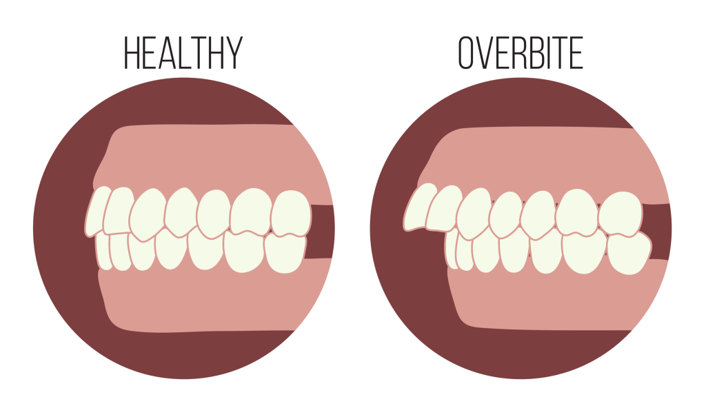 Hình ảnh mô phỏng tình trạng răng bình thường và hô hàm