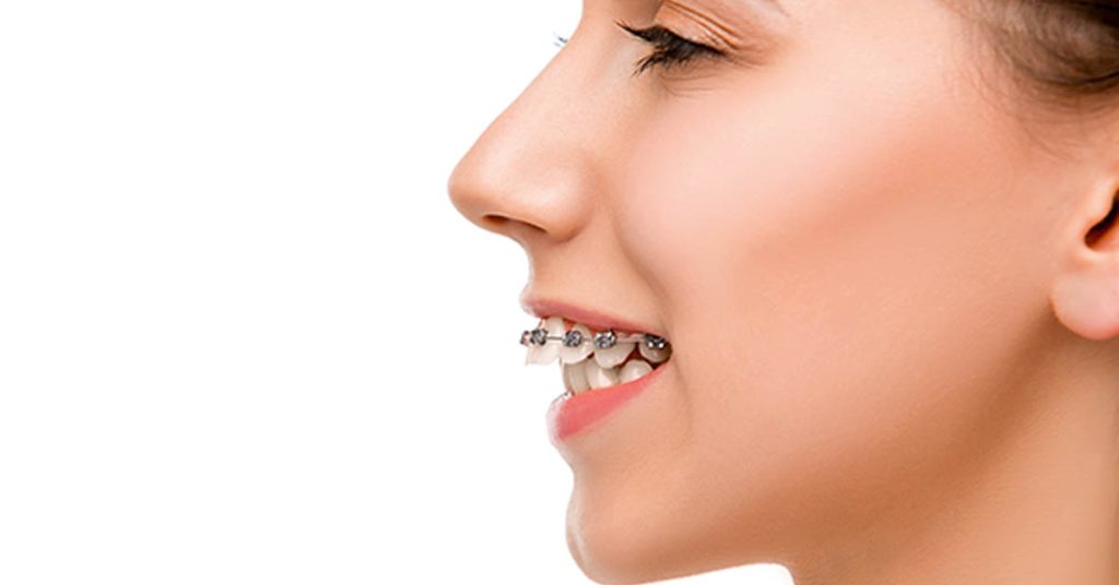 Hàm hô có nên niềng răng? Hàm hô nhẹ có thể cải thiện khá hiệu quả bằng chỉnh nha