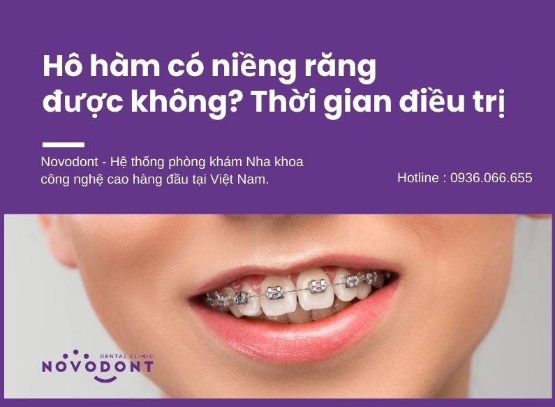 Hô hàm có niềng răng được không? Có thể cải thiện hô hàm qua chỉnh nha