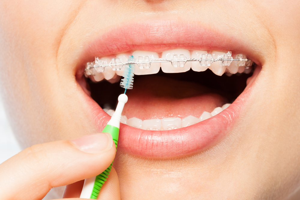 Nên chú ý vệ sinh răng miệng tránh để bị ố sứ khi niềng mắc cài sứ