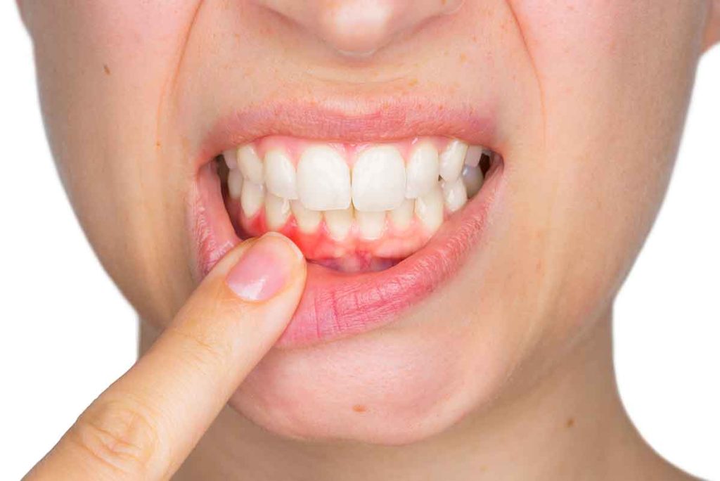 Mảng bám là nguyên nhân chính gây tụt lợi khi niềng răng và không niềng răng