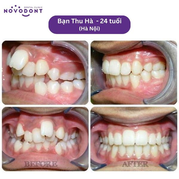 Niềng răng hô tại hệ thống Nha khoa Công nghệ Novodont - tối ưu hóa hiệu quả điều trị