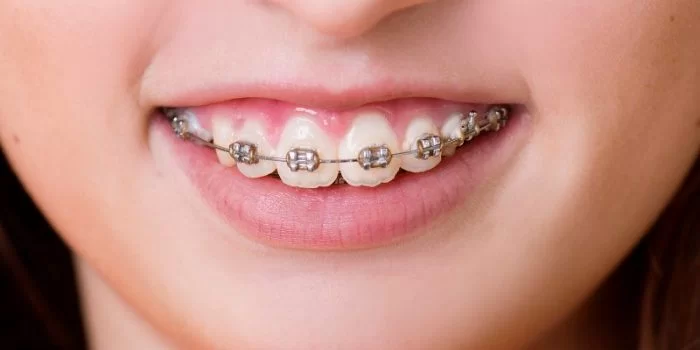 Thời gian niềng răng hô nhẹ phụ thuộc vào tình trạng, loại mắc cài, phác đồ điều trị của từng nha khoa