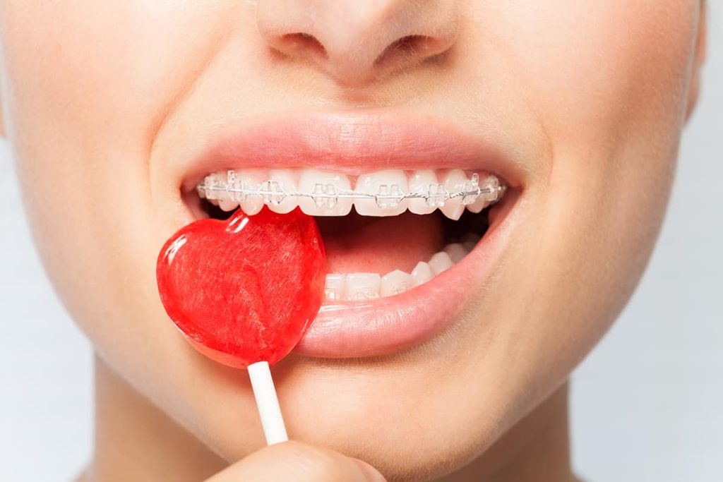 Niềng răng không nên ăn gì? Khi niềng, răng sẽ yếu hơn vì vậy bạn nên tránh đồ cứng 