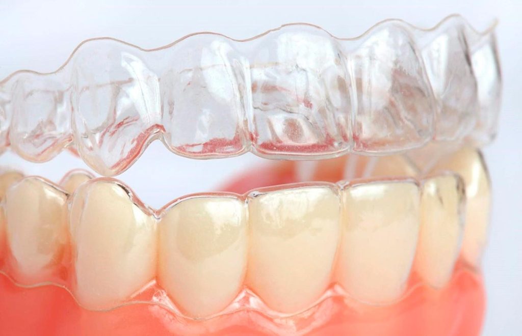 Niềng răng trong suốt được coi là phương pháp niềng có tính thẩm mỹ cao, ứng dụng công nghệ hiện đại nhất hiện nay 