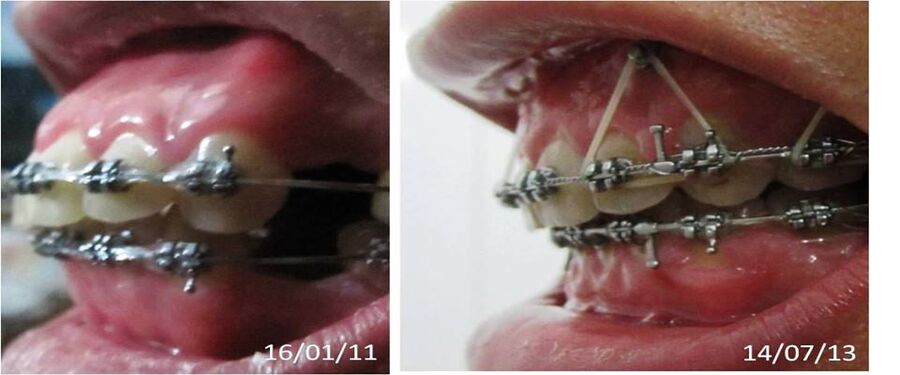 Hình ảnh bệnh nhân niềng răng hô. Tìm hiểu quy trình niềng răng hô