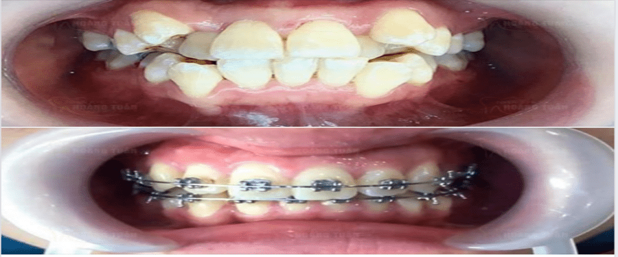 Hình ảnh bệnh nhân niềng răng khấp khểnh 
