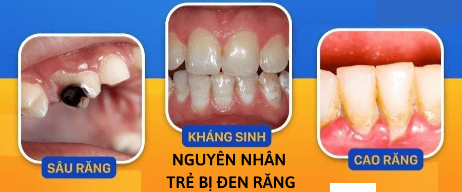Nguyên nhân khiến răng bé bị đen