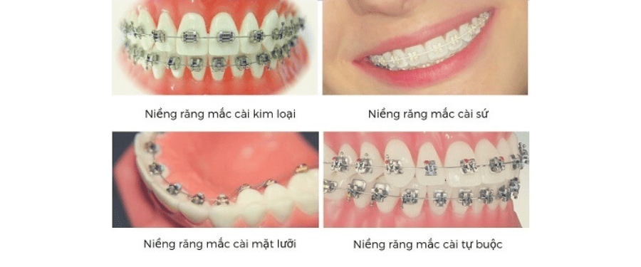 Hình 6. Minh họa các loại niềng răng mắc cài kim loại