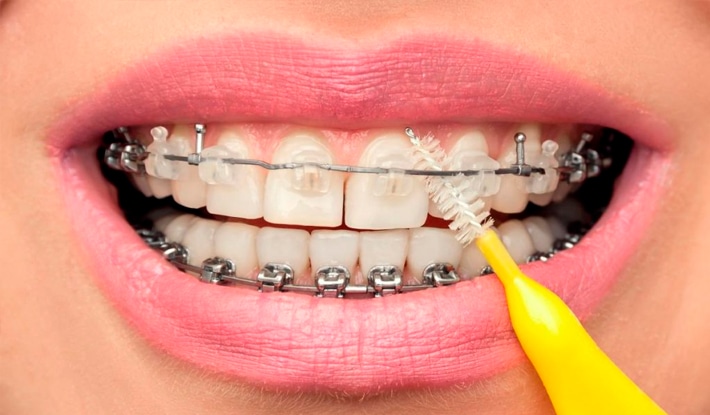 Bàn chải kẽ răng được khuyên dùng sau khi niềng răng