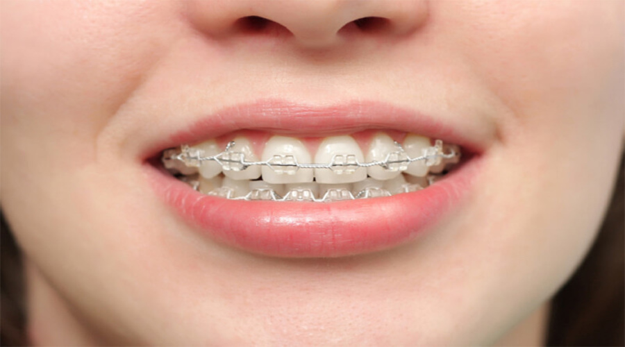 Tác dụng của niềng răng là giúp điều trị những tình trạng của khoang miệng như răng hô, móm, thưa, lệch lạc.