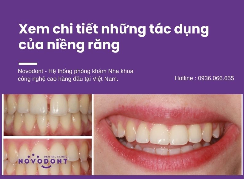 Tác dụng của niềng răng là gì? Giải thích vì sao nên chỉnh nha