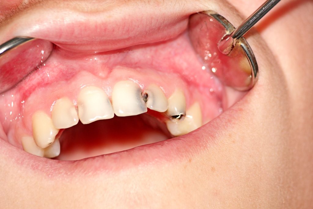 Sau khi trám răng sữa cho trẻ, phụ huynh nên theo dõi kỹ tình trạng  răng phát hiện các vấn đề như răng vẫn đau, bung trám