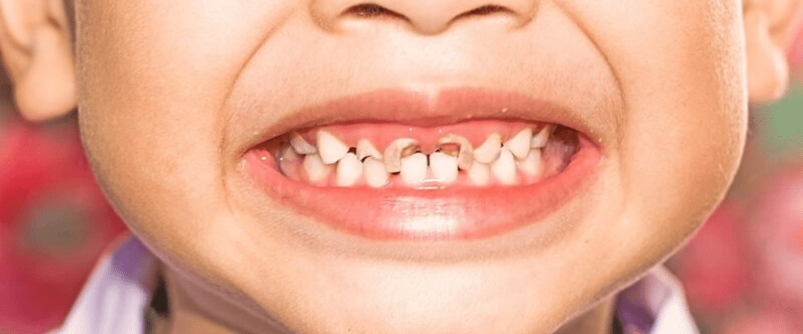 Nguyên nhân trẻ 15 tháng bị mủn răng