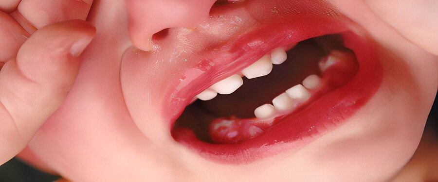 Cao răng gây ra viêm lợi 