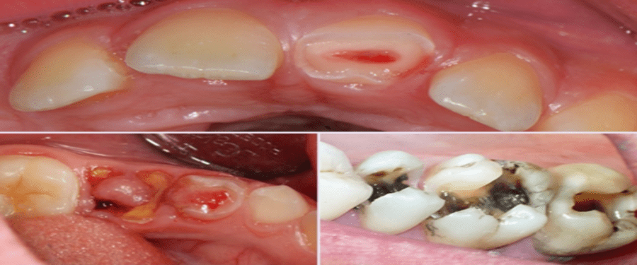 Một vài vấn đề xảy ra khi răng miệng của trẻ không được vệ sinh
