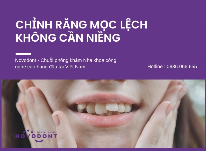 Chỉnh răng mọc lệch không cần niềng - Cách nào tốt nhất