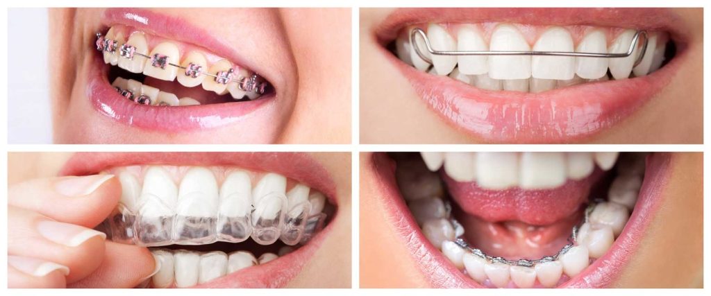 Các phương pháp niềng răng hô nhẹ