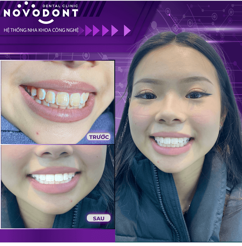 Hình ảnh trước và sau tẩy trắng răng ố vàng tại nha khoa Novodont