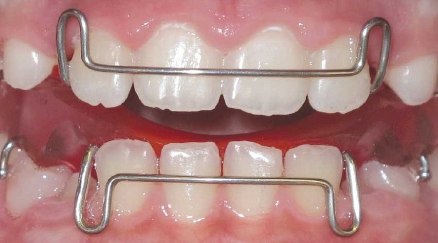Quá trình kéo cụm răng cửa mất bao lâu?