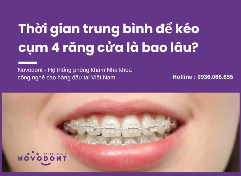 Kéo cụm 4 răng cửa mất bao lâu?