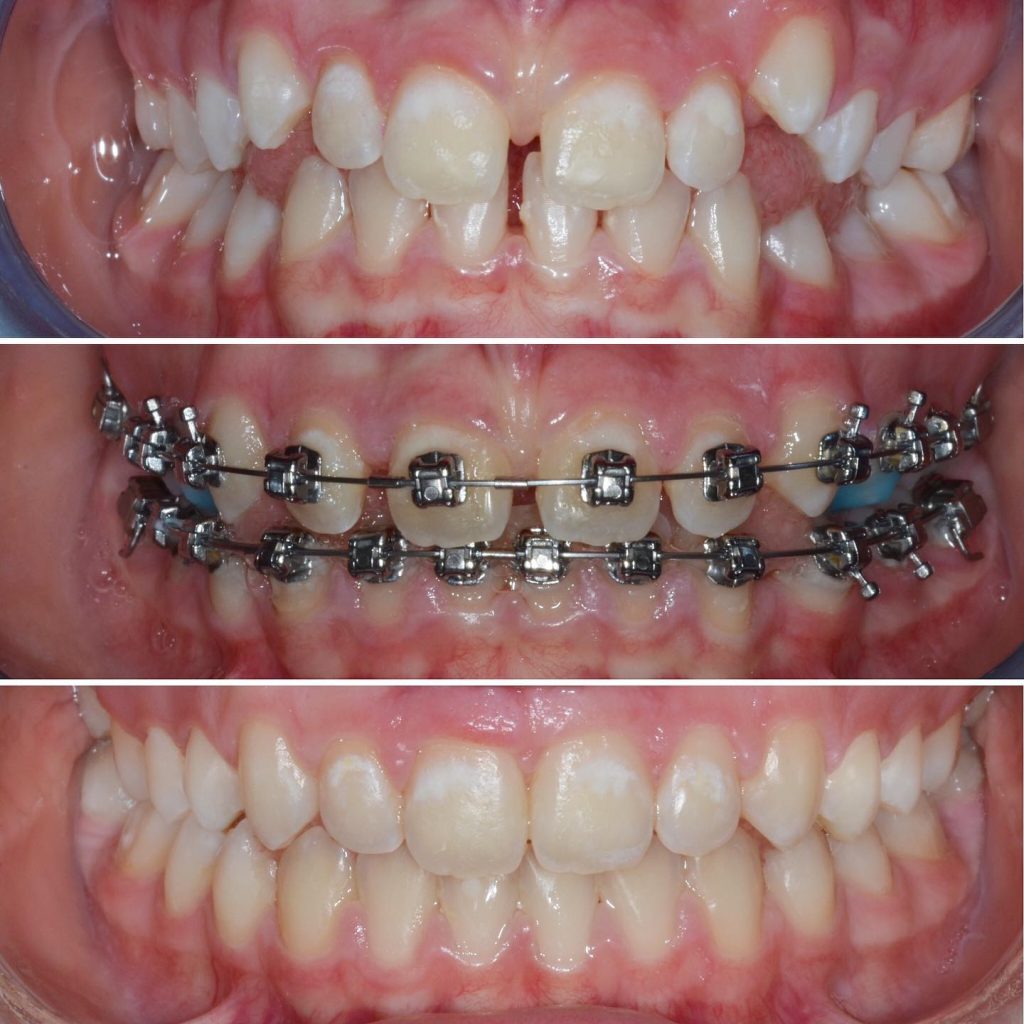 Niềng răng thông thường sẽ trải qua 5 giai đoạn chính 