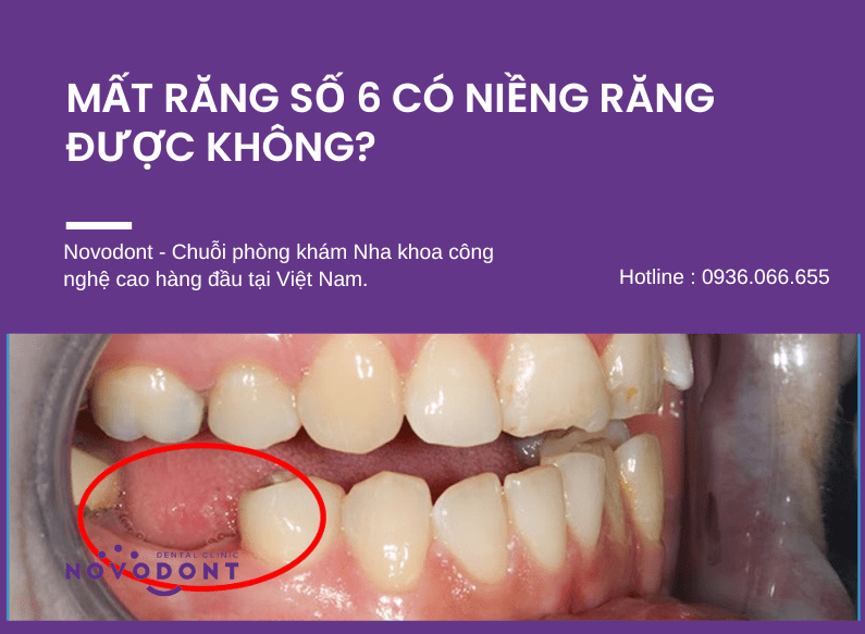 MẤT RĂNG SỐ 6 CÓ NIỀNG RĂNG ĐƯỢC KHÔNG? CÂU TRẢ LỜI VÀ GIẢI PHÁP HIỆU QUẢ